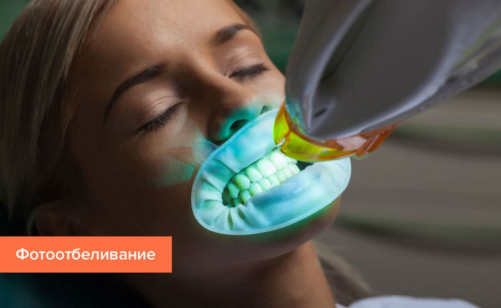 Фотоотбеливние зубов в Киеве - стоматология Фортуна